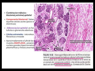 • Combinacion trifasica :
blastemal,estromal,epitelial
• Componente blastemal: Sabanas de
equeñas celulas azules (pocos signos
distintivos)
• -Diferenciacion epitelial: en forma de
tubulos o glomerulos abortivos
• Celulas estromales : naturaleza
fibrocitica o mixoide
• Aproximadamente el 5% de los tumores
muestra ANAPLASIA , presencia celulas
nucleos grandes,hipercromaticos y
pleomorficos y mitosis anormales
 