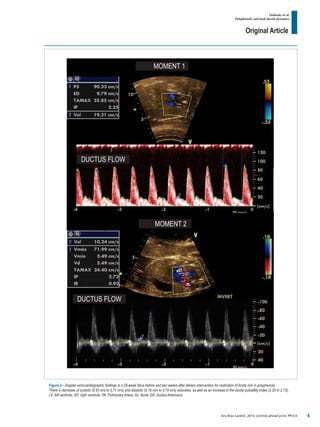 Original Article
Zielinsky et al.
Polyphenols and fetal ductal dynamics
Arq Bras Cardiol. 2013; [online].ahead print, PP.0-0
Figure 2 - Doppler echocardiographic findings in a 29-week fetus before and two weeks after dietary intervention for restriction of foods rich in polyphenols.
There is decrease of systolic (0.93 m/s to 0.71 m/s) and diastolic (0.19 m/s to 0.10 m/s) velocities, as well as an increase in the ductal pulsatility index (2.25 to 2.73).
LV: left ventricle; VD: right ventricle; PA: Pulmonary Artery; Ao: Aorta; DA: Ductus Arteriosus.
DUCTUS FLOW
DUCTUS FLOW
MOMENT 2
MOMENT 1
4
 