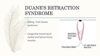 DUANE’S RETRACTION
SYNDROME
– Stilling –Turk-Duane
syndrome.
– Congenital miswiring of
medial and lateral rectus
muscles.
 