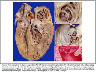 Restrictive cardiomyopathy