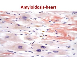 Amyloidosis-heart
 