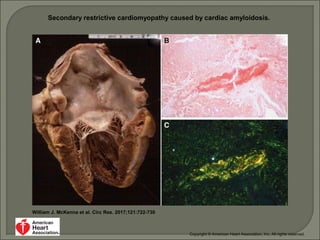Secondary restrictive cardiomyopathy caused by cardiac amyloidosis.
William J. McKenna et al. Circ Res. 2017;121:722-730
Copyright © American Heart Association, Inc. All rights reserved.
 