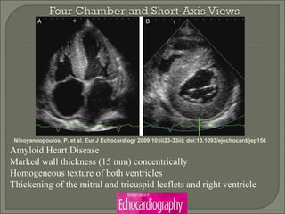 Nihoyannopoulos, P. et al. Eur J Echocardiogr 2009 10:iii23-33iii; doi:10.1093/ejechocard/jep156
Amyloid Heart Disease
Marked wall thickness (15 mm) concentrically
Homogeneous texture of both ventricles
Thickening of the mitral and tricuspid leaflets and right ventricle
 