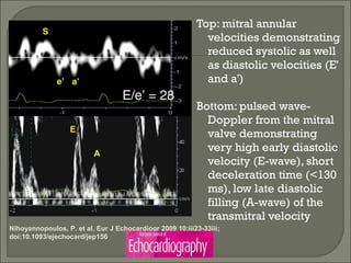 Top: mitral annular
velocities demonstrating
reduced systolic as well
as diastolic velocities (E'
and a')
Bottom: pulsed wave-
Doppler from the mitral
valve demonstrating
very high early diastolic
velocity (E-wave), short
deceleration time (<130
ms), low late diastolic
filling (A-wave) of the
transmitral velocity
Nihoyannopoulos, P. et al. Eur J Echocardiogr 2009 10:iii23-33iii;
doi:10.1093/ejechocard/jep156
 