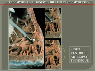 RIGHT
VENTRICUL
AR BIOPSY
TECHNIQUE
ENDOMYOCARDIAL BIOPSY IN DILATED CARDIOMYOPATHY
 