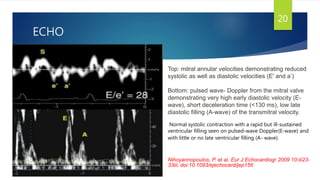 ECHO
20
Top: mitral annular velocities demonstrating reduced
systolic as well as diastolic velocities (E' and a’)
Bottom: pulsed wave- Doppler from the mitral valve
demonstrating very high early diastolic velocity (E-
wave), short deceleration time (<130 ms), low late
diastolic filling (A-wave) of the transmitral velocity.
Normal systolic contraction with a rapid but ill-sustained
ventricular filling seen on pulsed-wave Doppler(E-wave) and
with little or no late ventricular filling (A- wave).
Nihoyannopoulos, P. et al. Eur J Echocardiogr 2009 10:iii23-
33iii; doi:10.1093/ejechocard/jep156
 