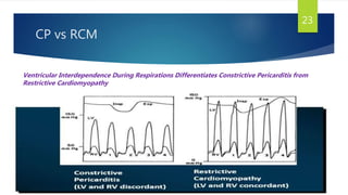CP vs RCM
23
Ventricular Interdependence During Respirations Differentiates Constrictive Pericarditis from
Restrictive Cardiomyopathy
 