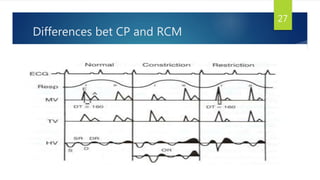 Differences bet CP and RCM
27
 