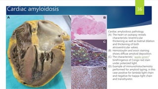 Cardiac amyloidosis 36
Cardiac amyloidosis pathology.
(A) The heart on autopsy reveals
characteristic biventricular
thickening as well as biatrial dilation
and thickening of both
atrioventricular valves.
(B) Hemotoxylin and eosin staining
shows diffuse amyloid deposition.
(C) The characteristic “apple-green”
birefringence of Congo red stain
under polarized light.
(D) Example of immunohistochemistry
performed for amyloid typing, in this
case positive for lambda light chain
and negative for kappa light chain
and transthyretin
 