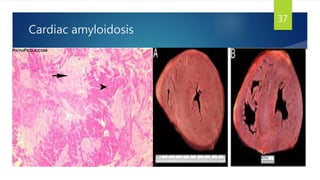 Cardiac amyloidosis
37
 