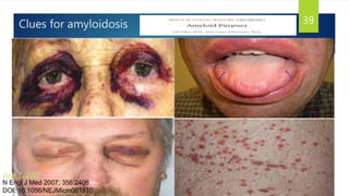 Clues for amyloidosis 39
June 7, 2007
N Engl J Med 2007; 356:2406
DOI: 10.1056/NEJMicm061510
 