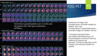 FDG PET 41
Paired sets of images with
nonattenuation-corrected images are
labeled “rest,” and
corresponding CT-based attenuation-
corrected images are labeled “rest AC.”
The patient had heart failure
and marked wall thickening on his
echocardiogram; he did not have any
evidence of a plasma cell
dyscrasia. The heart avidly took up the
isotope (a normal heart exhibits no
uptake).
Technetium pyrophosphate scan in an 81-year-
old patient with wild-type amyloidosis
(ATTRwt.).
 