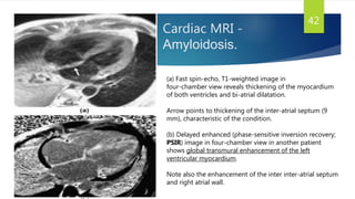 Cardiac MRI -
Amyloidosis.
42
(a) Fast spin-echo, T1-weighted image in
four-chamber view reveals thickening of the myocardium
of both ventricles and bi-atrial dilatation.
Arrow points to thickening of the inter-atrial septum (9
mm), characteristic of the condition.
(b) Delayed enhanced (phase-sensitive inversion recovery;
PSIR) image in four-chamber view in another patient
shows global transmural enhancement of the left
ventricular myocardium.
Note also the enhancement of the inter inter-atrial septum
and right atrial wall.
 