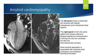 Amyloid cardiomyopathy
43
The left panel shows a thickened
left ventricle with biatrial
enlargement and a thickened atrial
septum.
The right panel is from the same
patient and shows extensive
delayed gadolinium enhancement
involving not only the ventricles
but also the
atria extensively (arrows).
Atrial amyloid deposition is
associated with impaired atrial
contraction and intraatrial
thrombus formation.
 