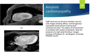 Amyloid
cardiomyopathy
44
CMR short axis (a) and four-chamber view (b).
LGE images showing diffuse, nonhomogenous
myocardial enhancement involving both
ventricles and atria. The pattern of enhancement
is consistent with cardiac amyloidosis. Note the
presence of a right atrial thrombus. Images
courtesy of Professor Dr. Jan Bogaert, University
Hospital Leuven.
 