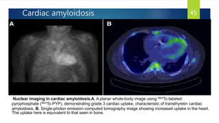 Cardiac amyloidosis 45
Nuclear imaging in cardiac amyloidosis.A, A planar whole-body image using 99mTc-labeled
pyrophosphate (99mTc-PYP), demonstrating grade 3 cardiac uptake, characteristic of transthyretin cardiac
amyloidosis. B, Single-photon emission computed tomography image showing increased uptake in the heart.
The uptake here is equivalent to that seen in bone.
 