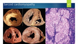 Sarcoid cardiomyopathy 47
 