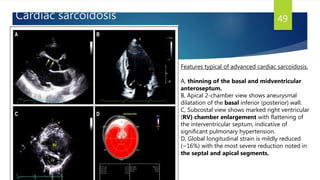 Cardiac sarcoidosis 49
Features typical of advanced cardiac sarcoidosis.
A, thinning of the basal and midventricular
anteroseptum.
B, Apical 2-chamber view shows aneurysmal
dilatation of the basal inferior (posterior) wall.
C, Subcostal view shows marked right ventricular
(RV) chamber enlargement with flattening of
the interventricular septum, indicative of
significant pulmonary hypertension.
D, Global longitudinal strain is mildly reduced
(−16%) with the most severe reduction noted in
the septal and apical segments.
 