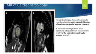 CMR of Cardiac sarcoidosis 52
Noncontrast image shows left ventricular
chamber dilatation with marked thinning
of the interventricular septum (arrows).
B, Postcontrast image shows focal
transmural late gadolinium enhancement
involving the entire interventricular
septum (arrows).
 