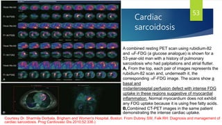 Cardiac
sarcoidosis
53
A combined resting PET scan using rubidium-82
and 18F-FDG (a glucose analogue) is shown for a
53-year-old man with a history of pulmonary
sarcoidosis who had palpitations and atrial flutter.
A, From the top, each pair of images represents the
rubidium-82 scan and, underneath it, the
corresponding 18F-FDG image. The scans show a
basal and
midanteroseptal perfusion defect with intense FDG
uptake in these regions suggestive of myocardial
inflammation. Normal myocardium does not exhibit
any FDG uptake because it is using free fatty acids.
B,Combined CT-PET images in the same patient
demonstrating the intense cardiac uptake.
Courtesy Dr. Sharmila Dorbala, Brigham and Women's Hospital, Boston. From Dubrey SW, Falk RH: Diagnosis and management of
cardiac sarcoidosis. Prog Cardiovasc Dis 2010;52:336.)
 