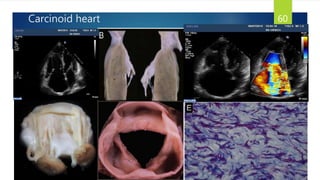 Carcinoid heart 60
 