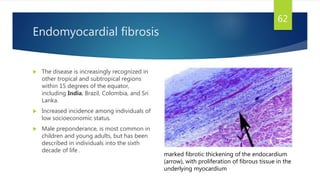Endomyocardial fibrosis
 The disease is increasingly recognized in
other tropical and subtropical regions
within 15 degrees of the equator,
including India, Brazil, Colombia, and Sri
Lanka.
 Increased incidence among individuals of
low socioeconomic status.
 Male preponderance, is most common in
children and young adults, but has been
described in individuals into the sixth
decade of life .
62
marked fibrotic thickening of the endocardium
(arrow), with proliferation of fibrous tissue in the
underlying myocardium
 