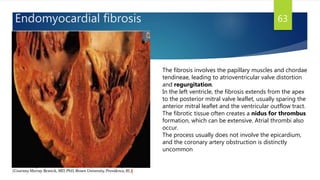 Endomyocardial fibrosis 63
The fibrosis involves the papillary muscles and chordae
tendineae, leading to atrioventricular valve distortion
and regurgitation.
In the left ventricle, the fibrosis extends from the apex
to the posterior mitral valve leaflet, usually sparing the
anterior mitral leaflet and the ventricular outflow tract.
The fibrotic tissue often creates a nidus for thrombus
formation, which can be extensive. Atrial thrombi also
occur.
The process usually does not involve the epicardium,
and the coronary artery obstruction is distinctly
uncommon
 