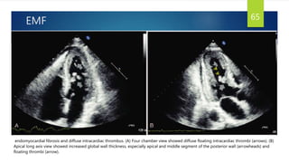 EMF 65
endomyocardial fibrosis and diffuse intracardiac thrombus. (A) Four chamber view showed diffuse floating intracardiac thrombi (arrows). (B)
Apical long axis view showed increased global wall thickness, especially apical and middle segment of the posterior wall (arrowheads) and
floating thrombi (arrow).
 