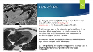 CMR of EMF
66
(a) Delayed, enhanced (PSIR) image in four-chamber view
shows the characteristic three-layered
appearance of this disease at the apex of the LV.
The innermost layer is the enhancing peripheral layer of the
thrombus (black arrowhead), the middle represents the
thrombus core, and the outermost layer represents the
enhancing subendocardium (arrows).
Additionally, there is subendocardial enhancement along the
right ventricular apex (white arrowhead).
(b) Fast spin-echo, T1-weighted image in four-chamber view in
another patient showing typical bi-ventricular apical
obliteration.
 