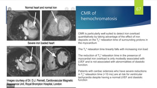 CMR of
hemochromatosis
67
CMR is particularly well suited to detect iron overload
quantitatively by taking advantage of the effect of iron
deposits on the T2* relaxation time of surrounding protons in
the myocardium
The T2* relaxation time linearly falls with increasing iron load
The reduction of T2* relaxation time in the presence of
myocardial iron overload is only modestly associated with
LVEF and is not associated with abnormalities of diastolic
function.
Patients with cardiac siderosis who have severe reductions
in T2* relaxation time (<10 ms) are at risk for ventricular
tachycardia despite having a normal LVEF and diastolic
function
 
