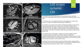 LGE in non
ischemic
CM
69
A 4-chamber view of patchy distribution of late midwall and epicardial late
gadolinium enhancement (LGE) (arrows) in a patient with cardiac sarcoidosis. (Top
right)
A 3-chamber view of a midwall stripe pattern of late gadolinium enhancement
(arrows) in a patient with dilated cardiomyopathy. (Middle left)
A 4-chamber view of patchy epicardial and midwall late gadolinium enhancement
along the lateral wall (arrows) in a patient with myocarditis. (Middle right) A
midventricular short-axis image in a patient with pulmonary hypertension (HTN)
with right ventricular (RV) dilation and hypertrophy (*) along with late gadolinium
enhancement in the anterior and inferior right ventricular insertion points (arrows).
(Bottom left)
A 3-chamber view of a LGE image in a patient with cardiac amyloid. The left
ventricular blood pool is nulled (*), and there is subtle circumferential
subendocardial late gadolinium enhancement throughout the left ventricle. The late
gadolinium enhancement is most pronounced at the base of the left ventricle within
hypertrophied myocardium (arrow). (Bottom right)
A midventricular short-axis image in a patient with hypertrophic cardiomyopathy
with evidence of asymmetrical septal hypertrophy with extensive midwall LGE within
the hypertrophied myocardium (arrows). CMP = cardiomyopathy.
 