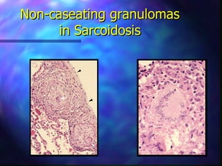 Non-caseating granulomas
      in Sarcoidosis
 
