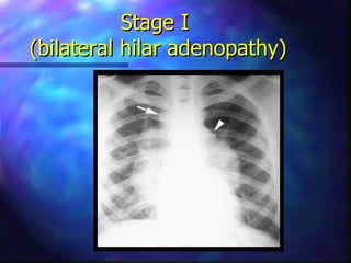 Stage I
(bilateral hilar adenopathy)
 