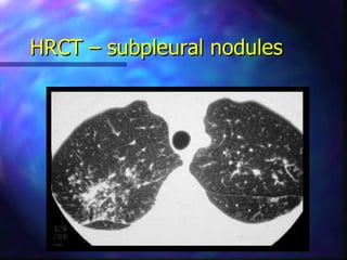 HRCT – subpleural nodules
 