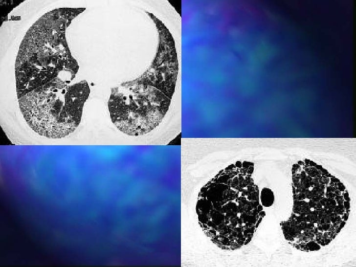 Restrictive lung disease