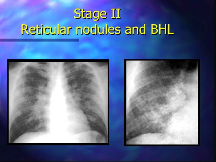 Restrictive lung disease