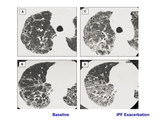 Baseline IPF Exacerbation
 