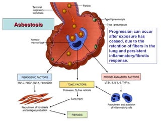 Progression can occur
after exposure has
ceased, due to the
retention of fibers in the
lung and persistent
inflammatory/fibrotic
response.
AsbestosisAsbestosis
 