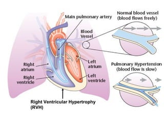 Right Ventricular Hypertrophy
(RVH)
 