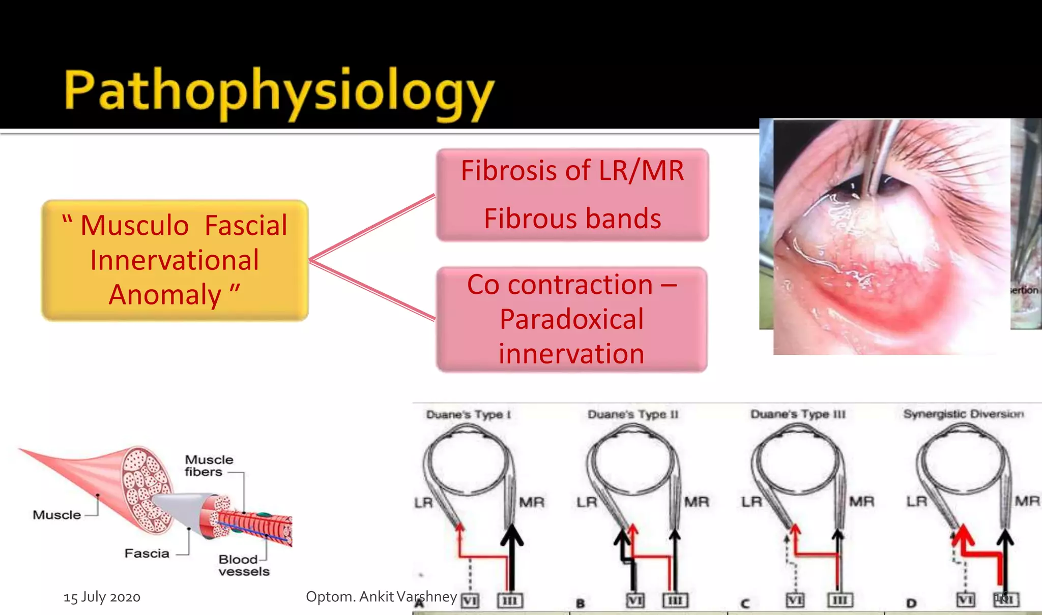 “ Musculo Fascial
Innervational
Anomaly ”
Fibrosis of LR/MR
Fibrous bands
Co contraction –
Paradoxical
innervation
15 July 2020 Optom.AnkitVarshney 16
 