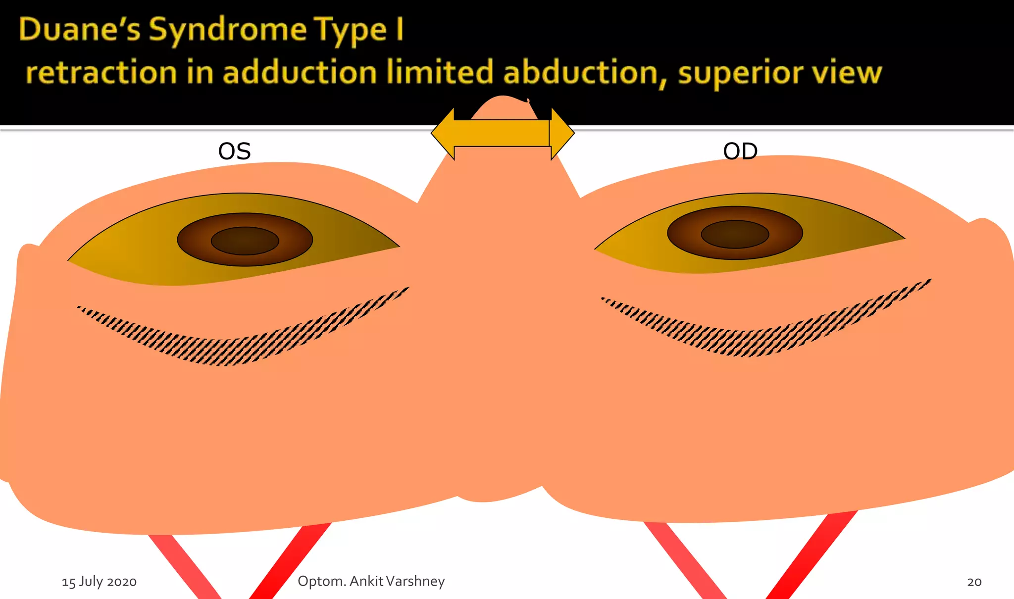OS OD
15 July 2020 Optom.AnkitVarshney 20
 