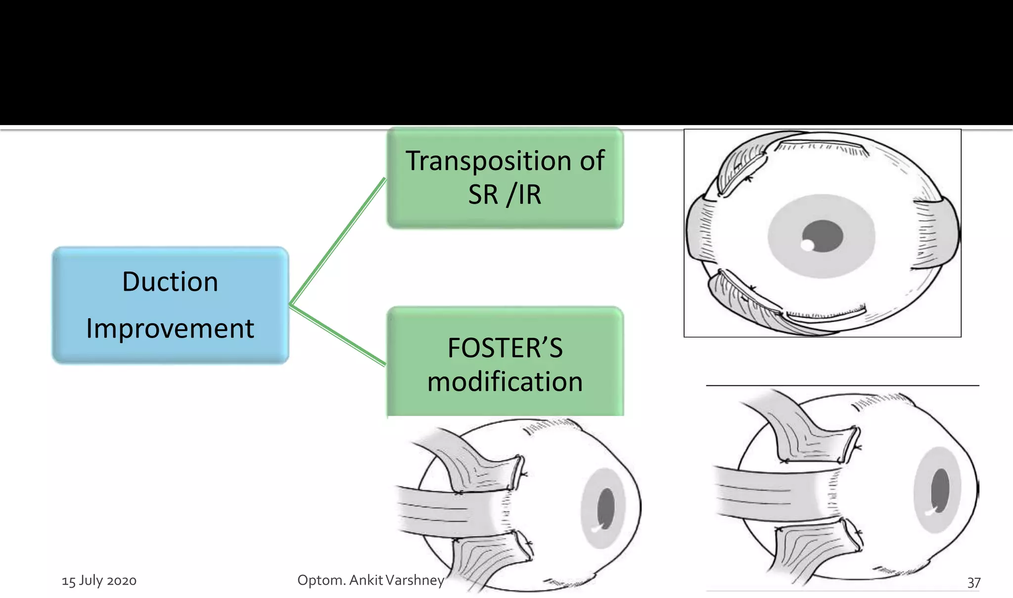Duction
Improvement
Transposition of
SR /IR
FOSTER’S
modification
15 July 2020 Optom.AnkitVarshney 37
 