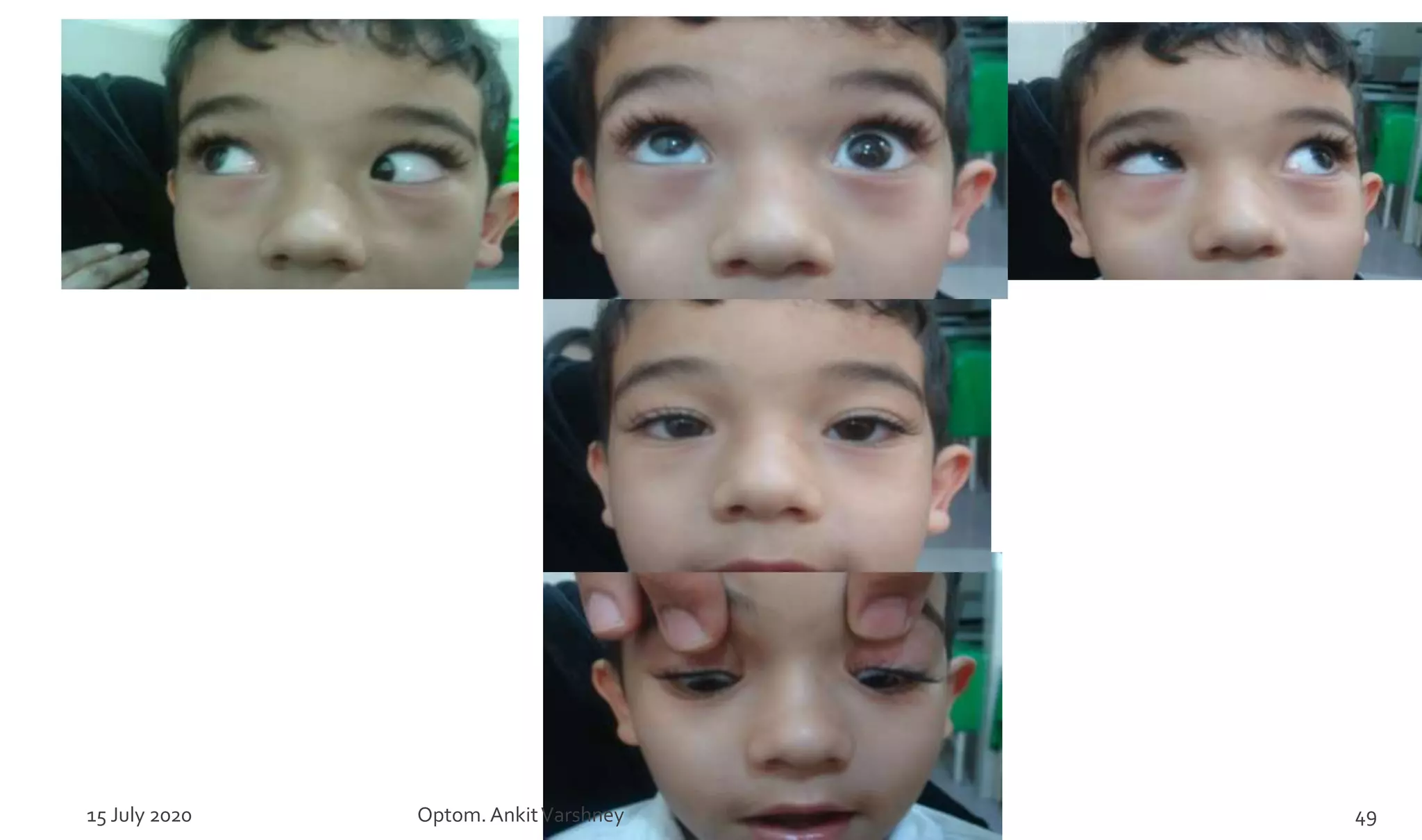 15 July 2020 Optom.AnkitVarshney 49
 