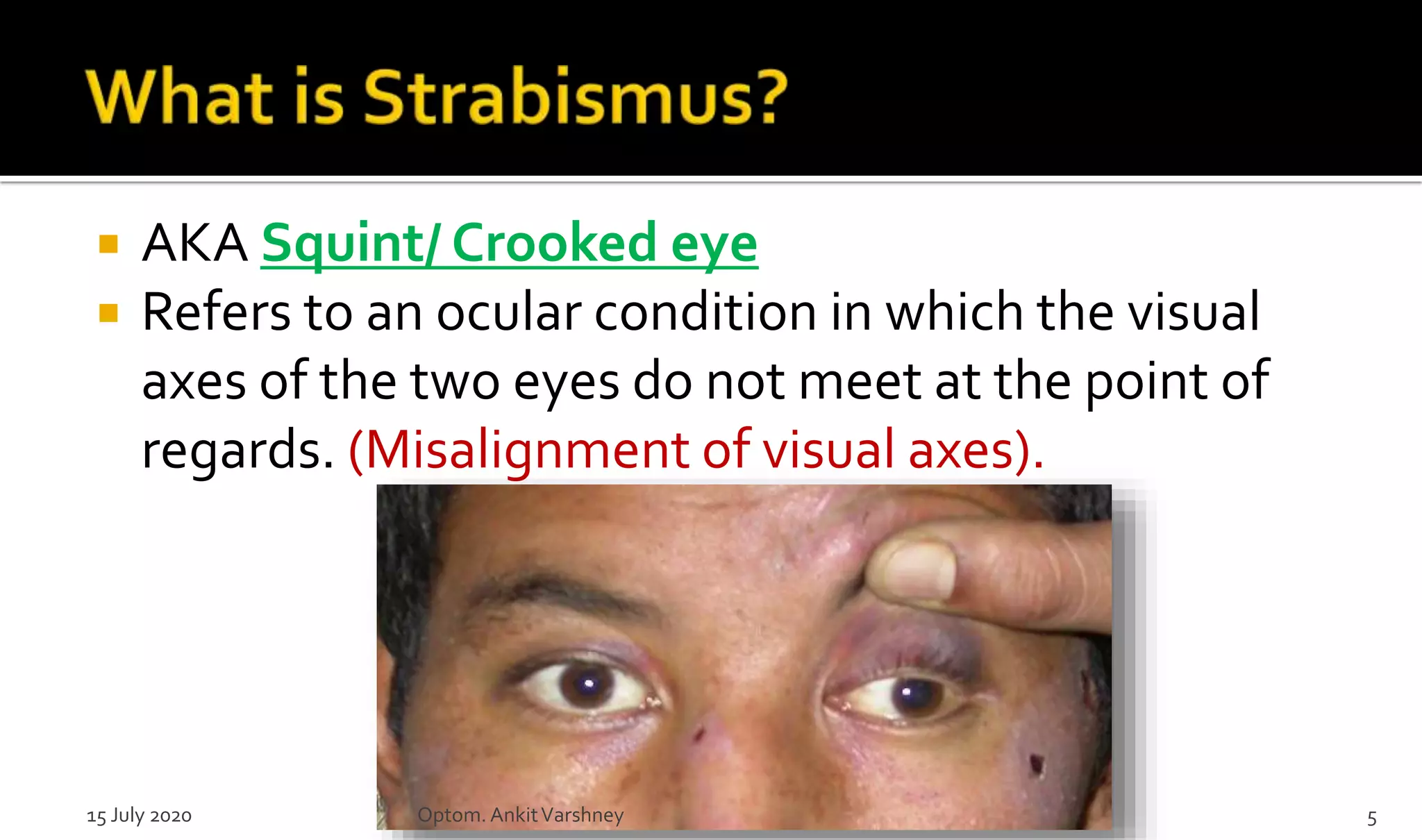  AKA Squint/ Crooked eye
 Refers to an ocular condition in which the visual
axes of the two eyes do not meet at the point of
regards. (Misalignment of visual axes).
15 July 2020 Optom.AnkitVarshney 5
 