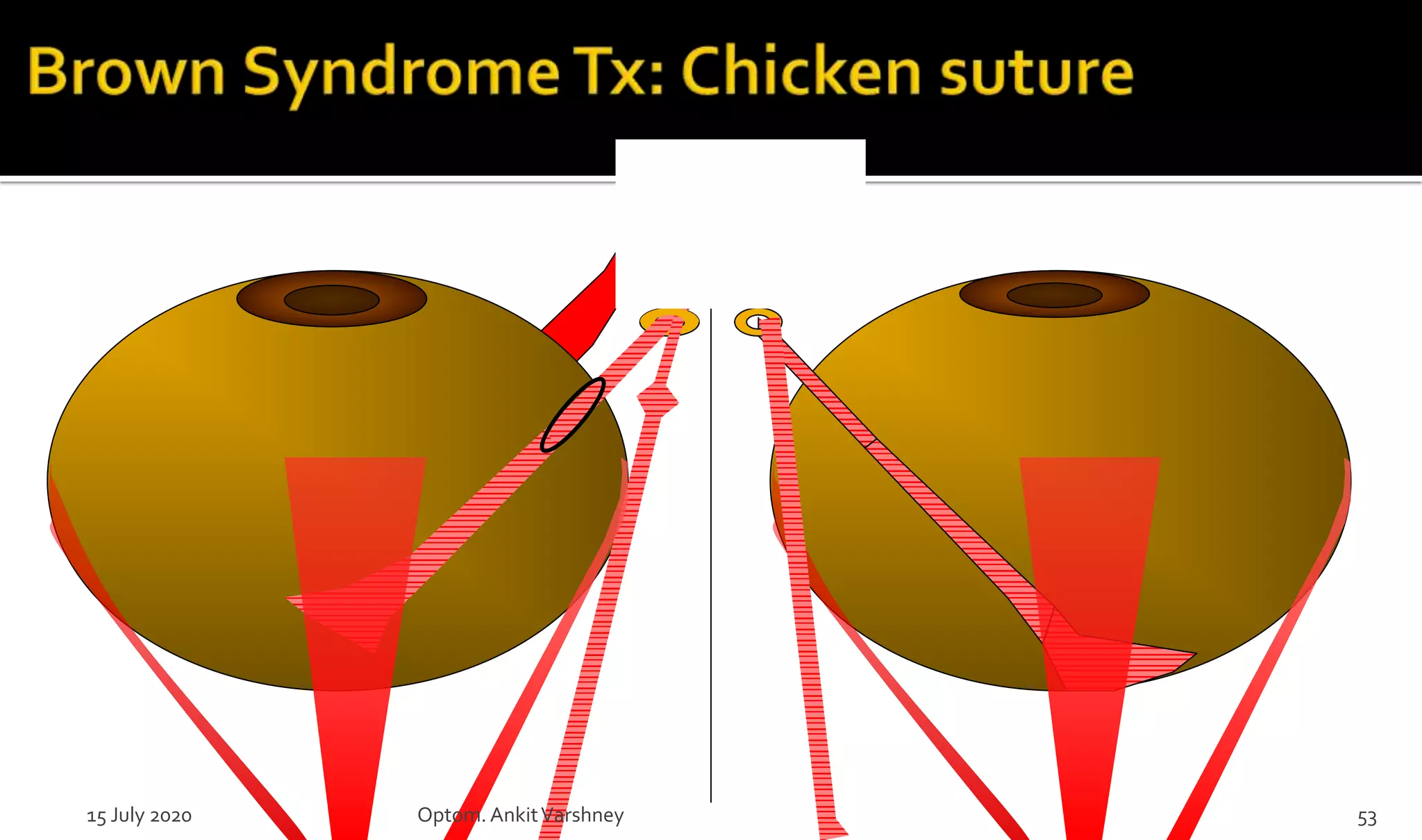 15 July 2020 Optom.AnkitVarshney 53
 