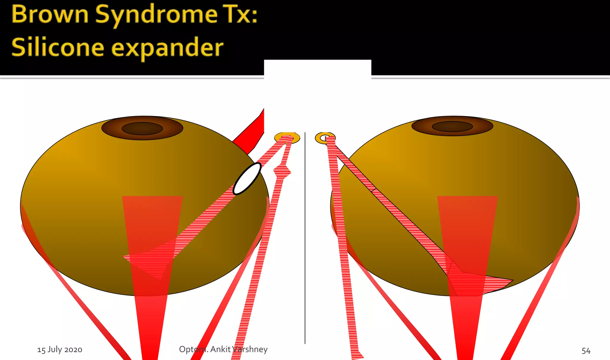 15 July 2020 Optom.AnkitVarshney 54
 