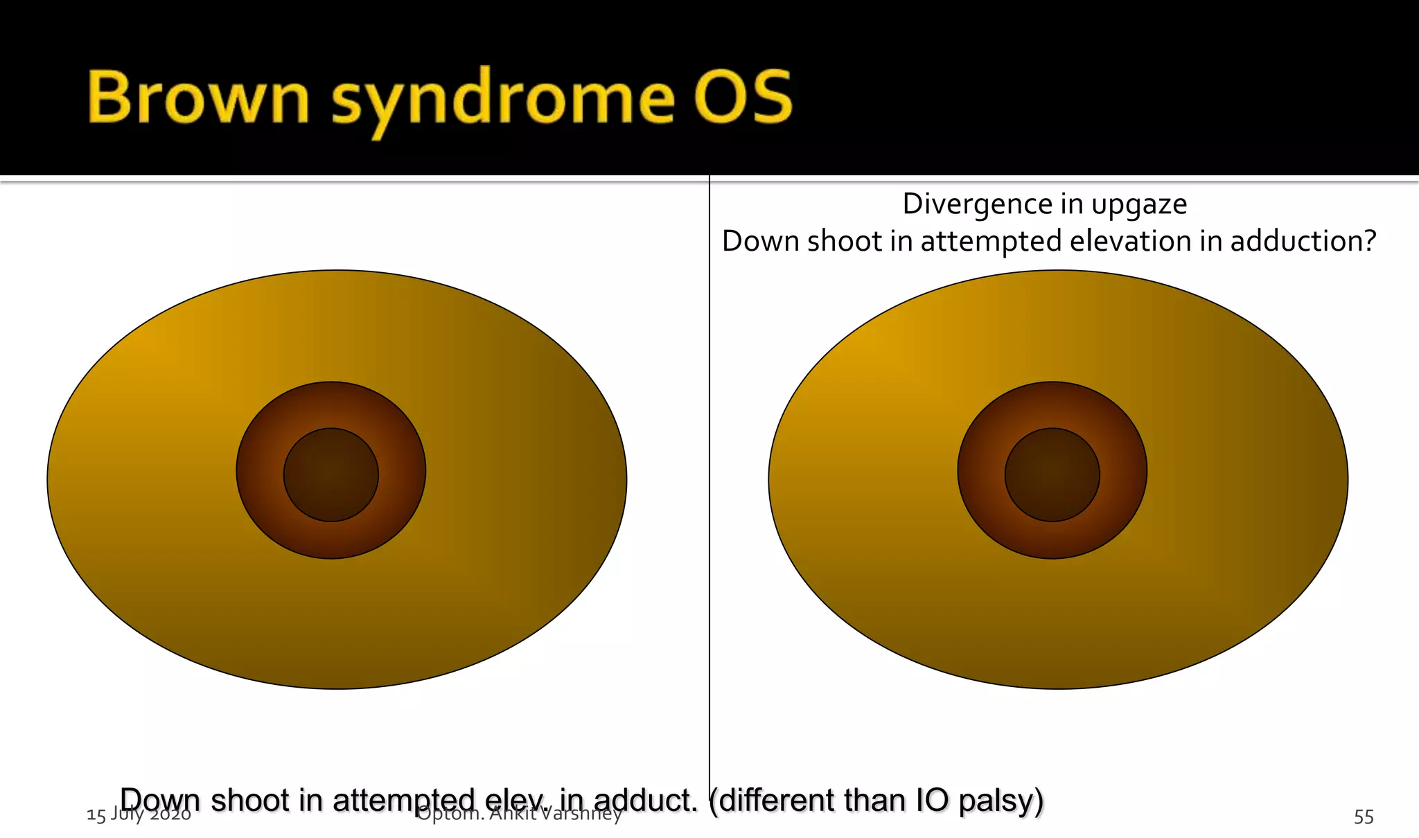 Divergence in upgaze
Down shoot in attempted elevation in adduction?
Down shoot in attempted elev. in adduct. (different than IO palsy)15 July 2020 Optom.AnkitVarshney 55
 