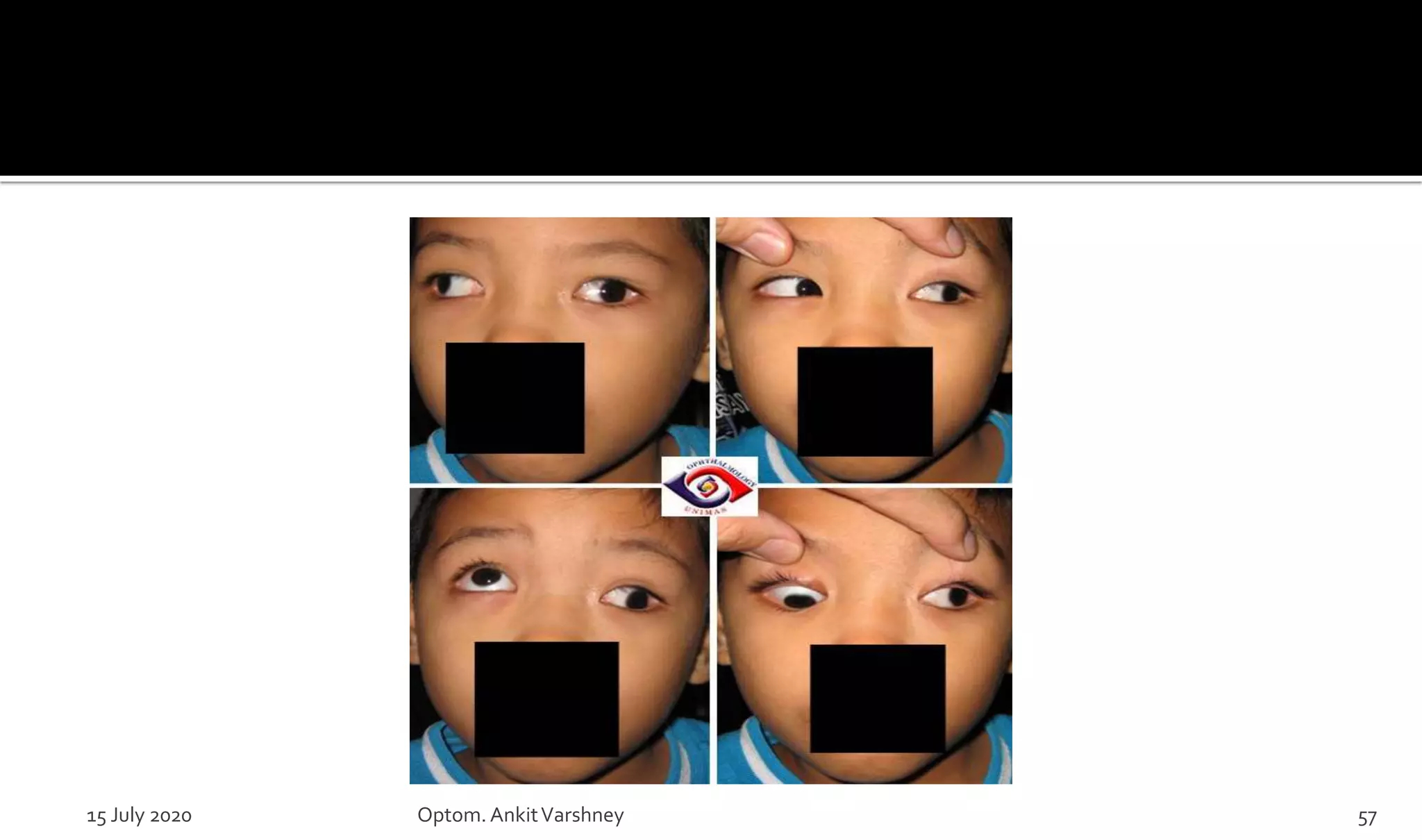 15 July 2020 Optom.AnkitVarshney 57
 