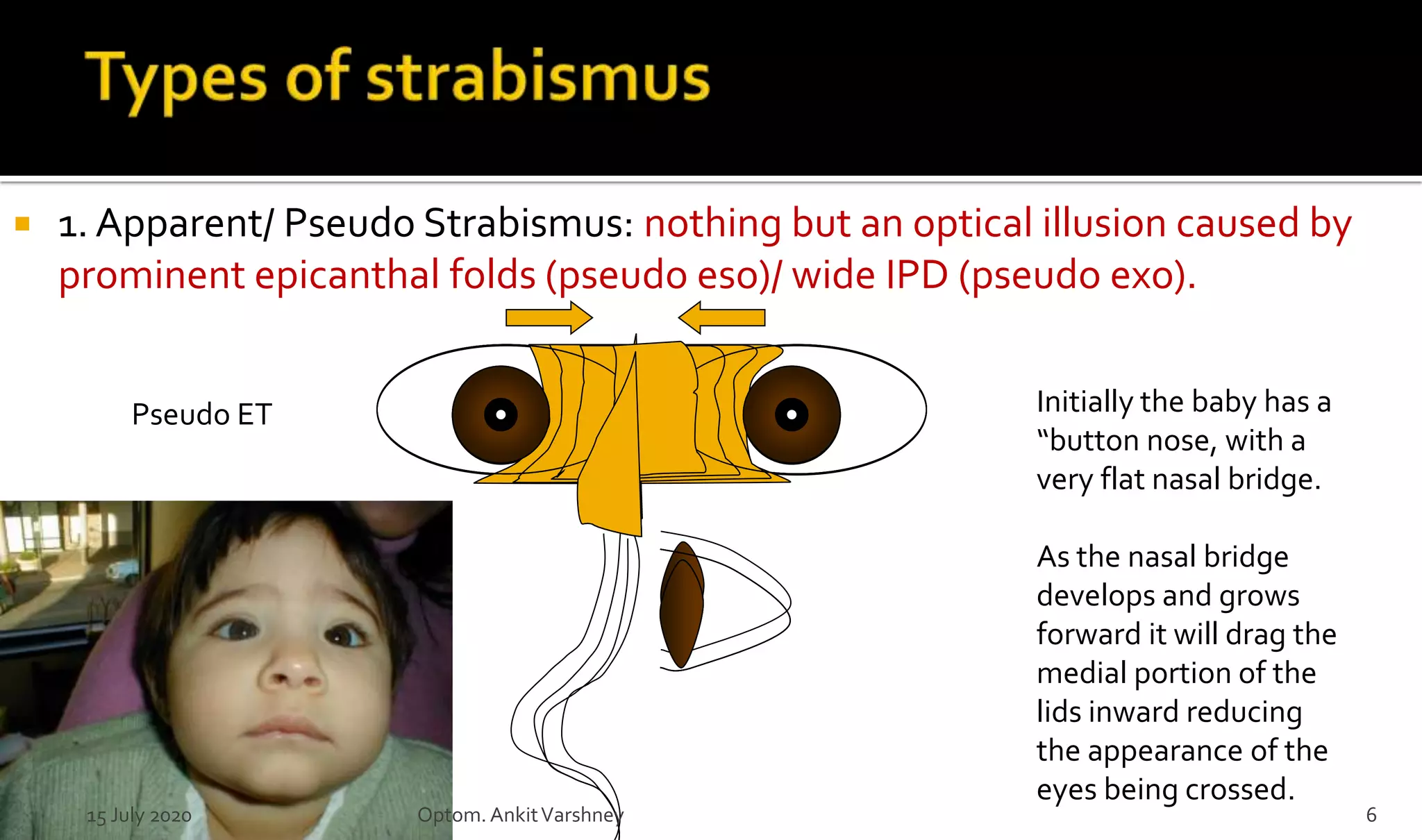  1. Apparent/ Pseudo Strabismus: nothing but an optical illusion caused by
prominent epicanthal folds (pseudo eso)/ wide IPD (pseudo exo).
Pseudo ET Initially the baby has a
“button nose, with a
very flat nasal bridge.
As the nasal bridge
develops and grows
forward it will drag the
medial portion of the
lids inward reducing
the appearance of the
eyes being crossed.
15 July 2020 Optom.AnkitVarshney 6
 