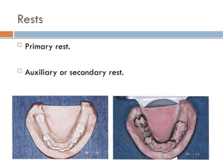 Rests
 Primary rest.
 Auxiliary or secondary rest.
 